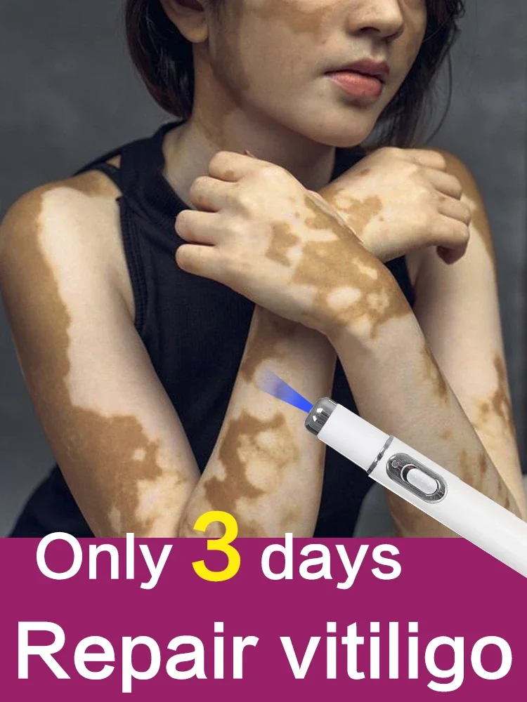 

Синяя лазерная ручка, эффективная лазерная технология быстро улучшения витилиго