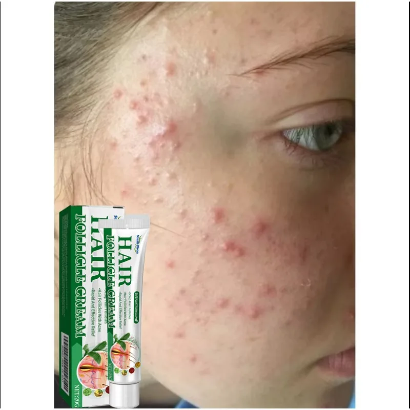 

Anti-Acne Cream Effectively Removes Skin Nodules Pustules Cysts Papules Blackheads Men And Women Acne Skin Care Essence Cream