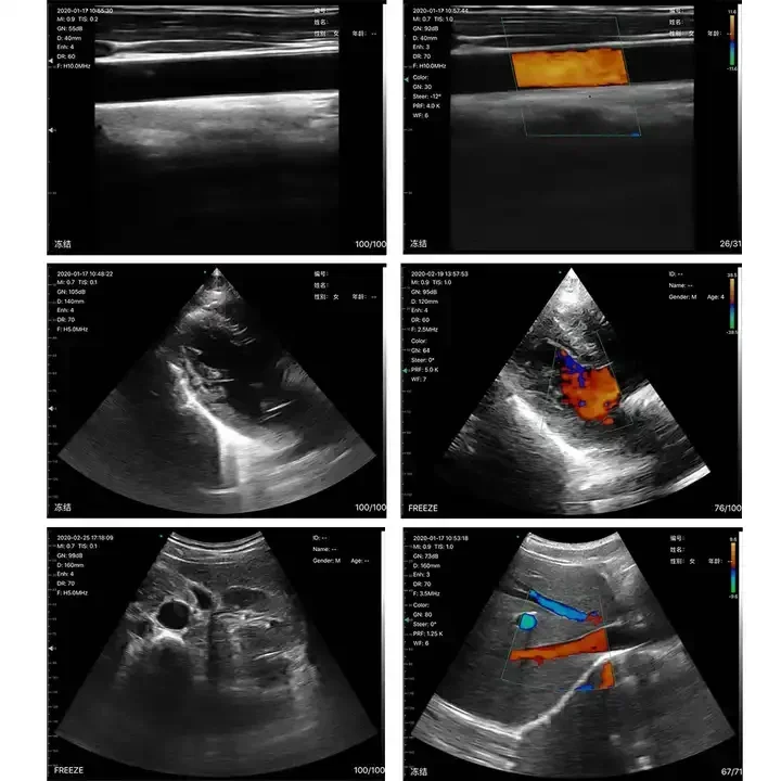 Sonografia Inalambrica Con Sonda  USB Triple En 1 Sondas Lineales Y Convexas Para Smartphone Exploracion Port