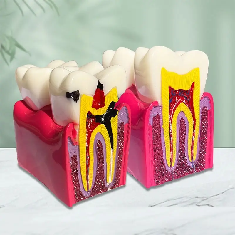 Dentistry, Oral 6x Caries Comparison Model Caries Evolution Process Doctor-patient Teaching Communication Display Model