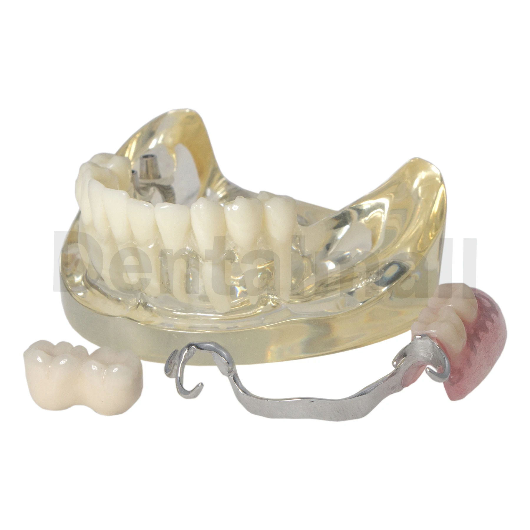 Dental Typodont Implant Restoration Teeth Model with Partial Denture Steel Bracket M6022