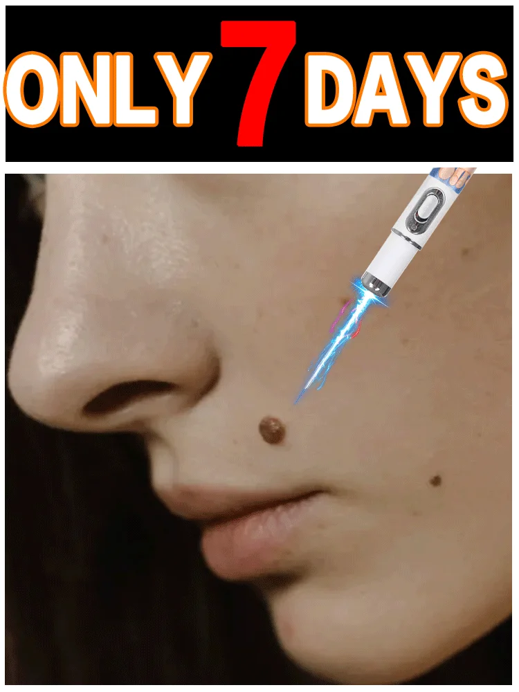 Hot Seller Upgraded Version Wart Removal Tools