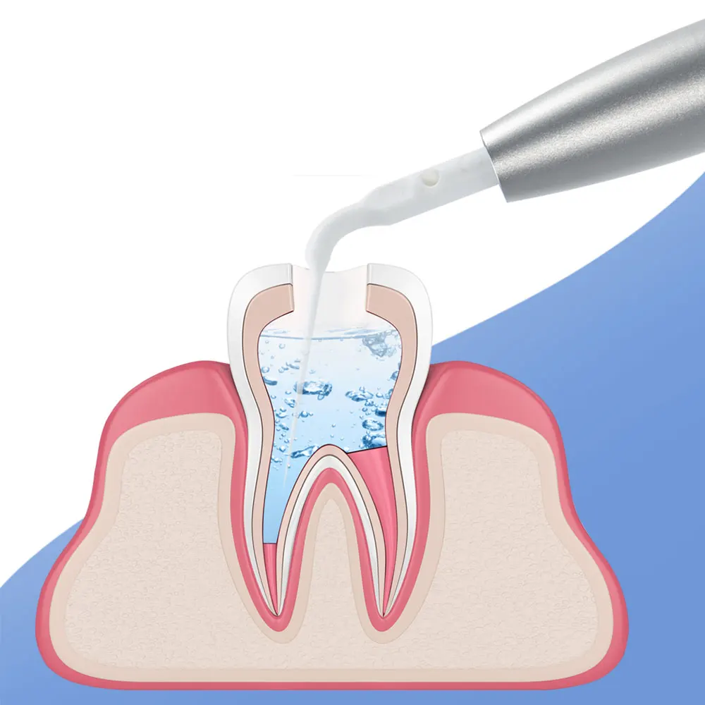 XND Dental ultradźwiękowy irygator kanał korzeniowy endodontium narzędzie ultradźwiękowy aktywator endoskopowy z 5 końcówkami 2/4 otwory