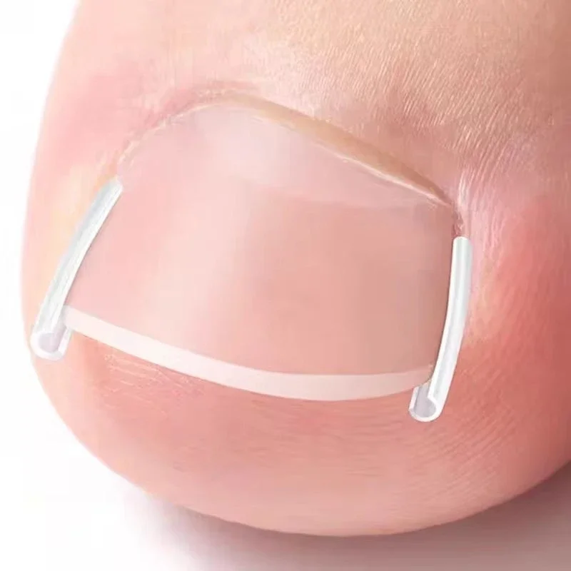 C-shaped Ingrown Toenail Corrector Ultra-thin Elastic Tube Pad Foot Care Toe Nails Treatment Straightening Clip Invisible Patch