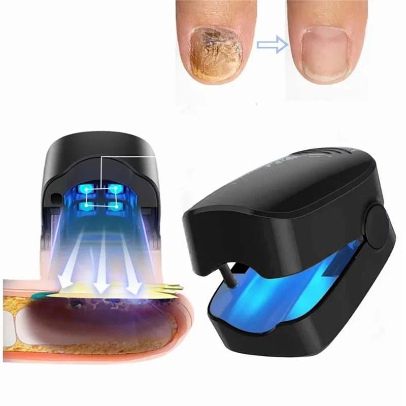 Dispositivo de tratamiento de hongos en las uñas: infrarrojo de 905 Nm y láser LED azul de 470 Nm, terapia eficaz de onicomicosis para uso doméstico
