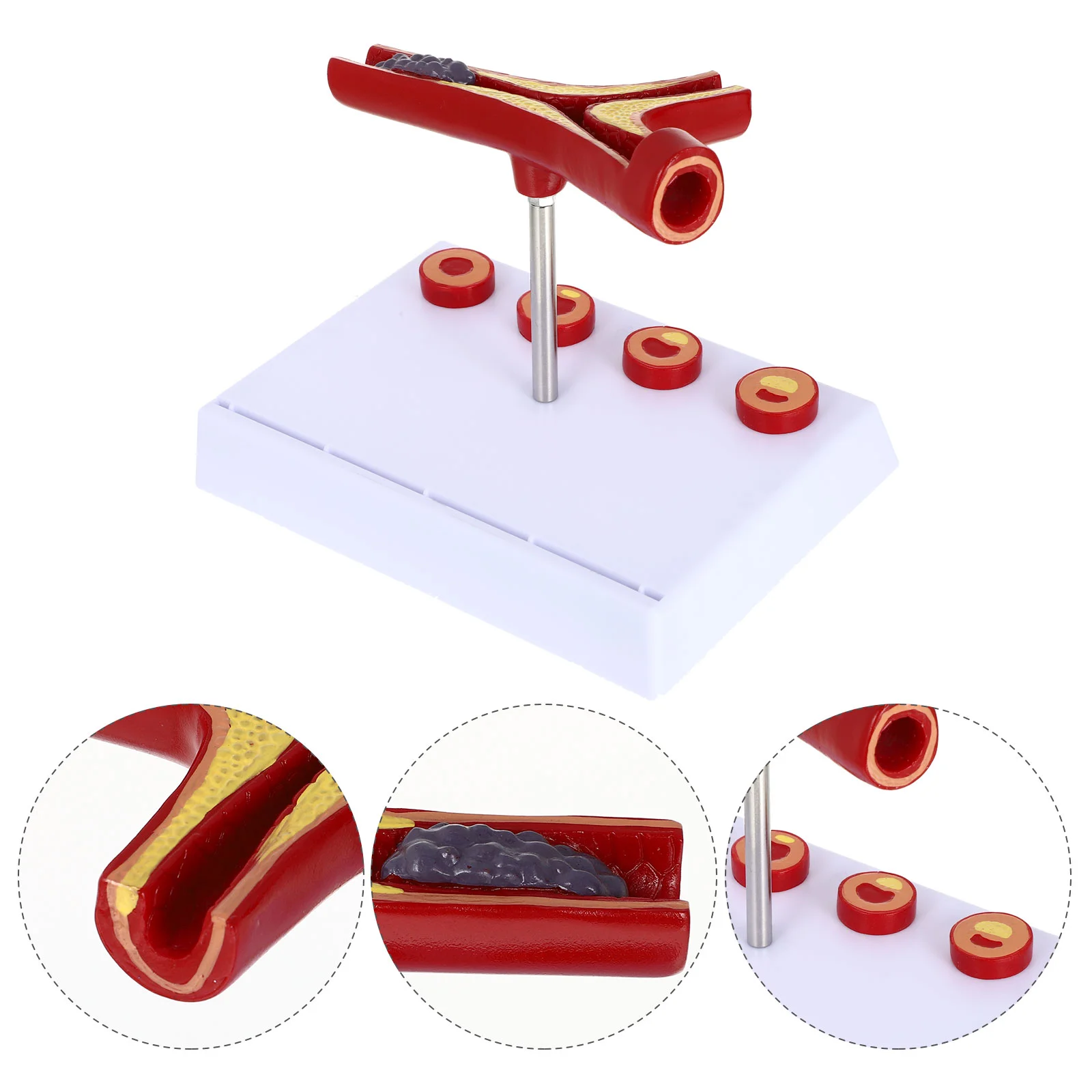 

Vascular Model Human Blood Vessel Cardiovascular Atherosclerosis Show Vacuum