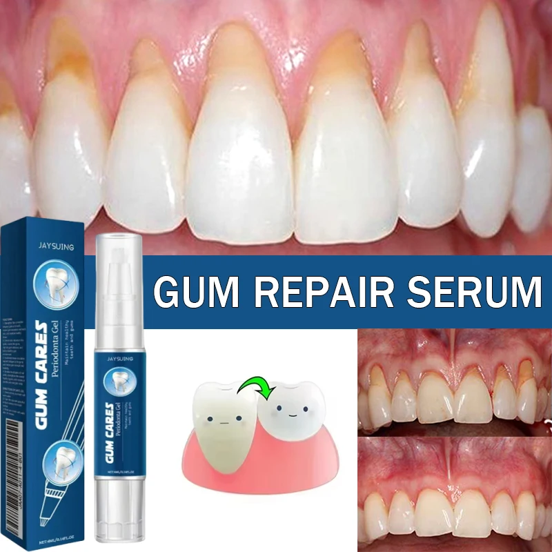 Gel Reparador de Encías Dañadas, Alivia el Dolor de Encías, Alergias, Limpieza Profunda de Manchas Dentales, Sérum para el Sarro, Pasta Dental para Caries