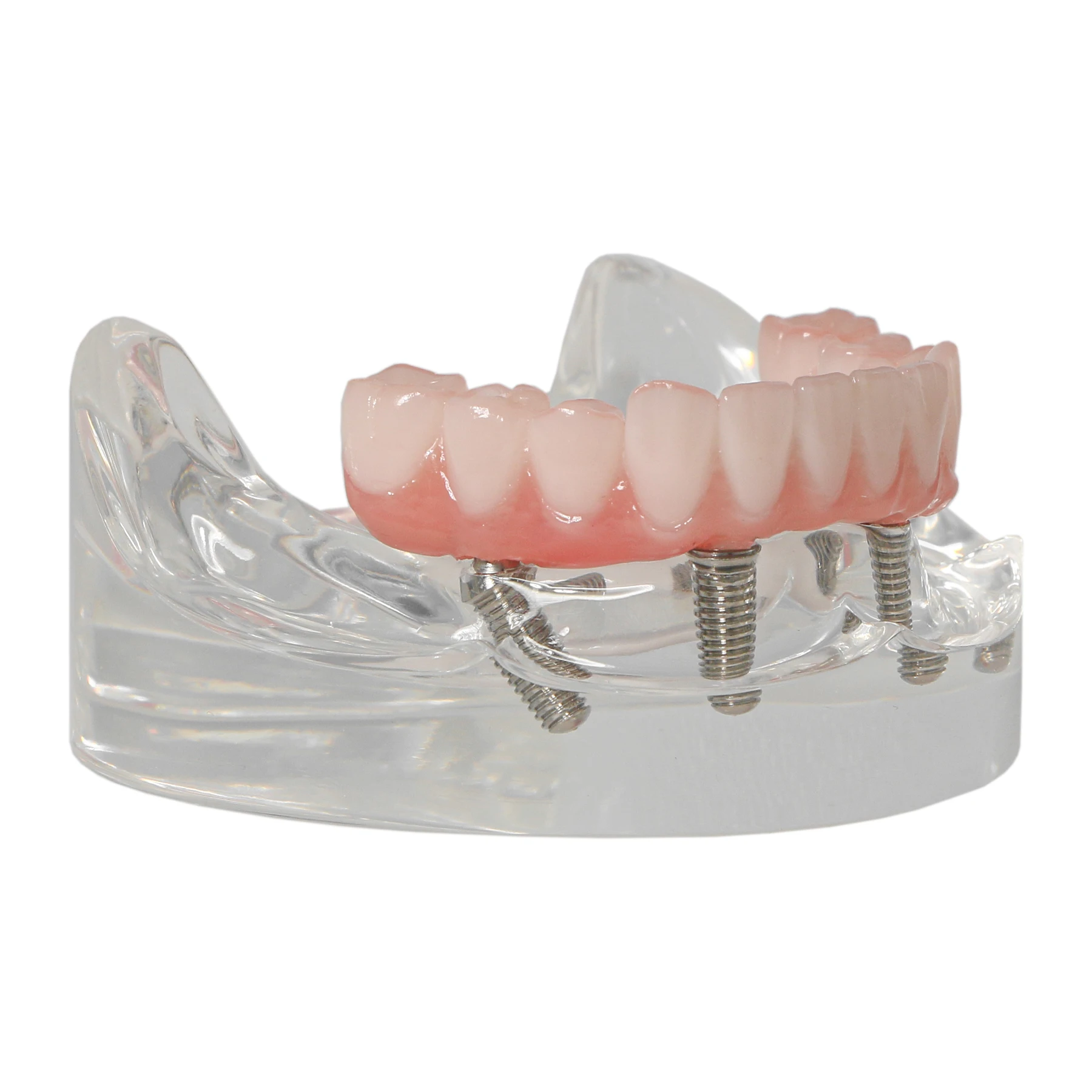 Dental Teeth Model All-on-4 Overdenture Implant Model Lower Jaw-Clear 4 Removable Screws with Post Core Bridge M6027