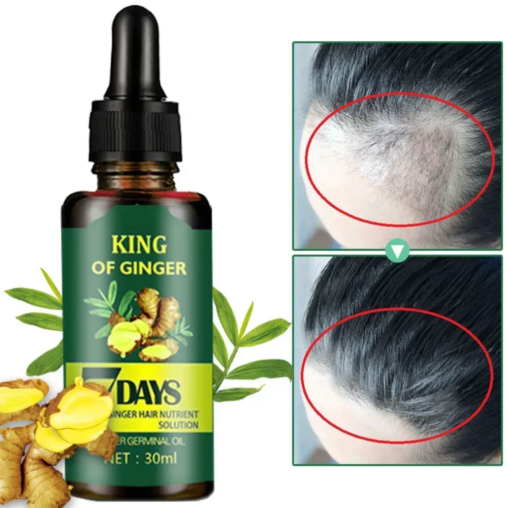 

King of Ginger Germinal Oil 30ml 7 Days Scalp Damaged Anti-loss Hair Fast Regrowth Strengthen The Root Improves Frizzy