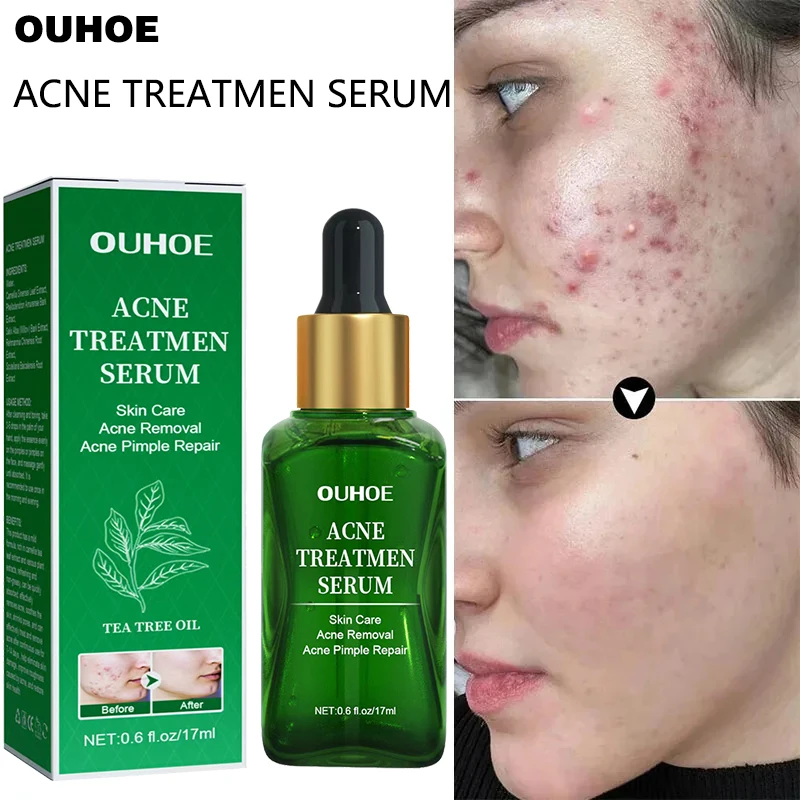 Acne Treatment Facial Serum Pore Shrinking Skin Care Against Face Acne Pimple Spots Remover Cleaning Shrink pores Tea Tree Serum