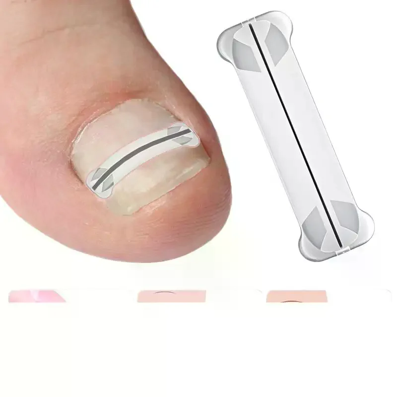 สติ๊กเกอร์แก้เล็บขบ 1 ชิ้น ขนาด 13-20 มม. แผ่นแก้เล็บขบ รักษาเล็บขบ ฟื้นฟูเล็บ แก้เล็บขบ อุปกรณ์ทำเล็บเท้า