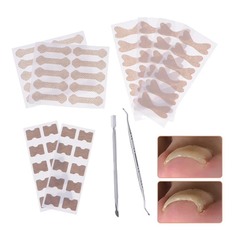 10 Stuks Ingegroeide Teennagel Correctie Sticker Set Zelfklevende Teennagel Patch Elastische Nagel Behandeling Corrector Sticker Voetverzorging Tools