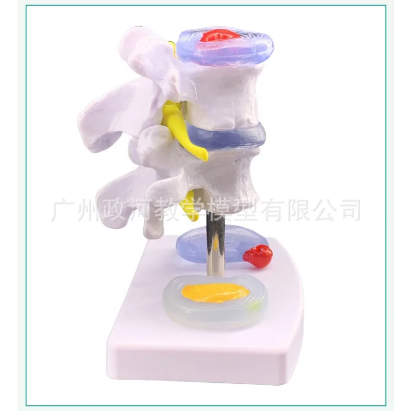 Human Lumbar Disc Herniation Anatomy Model Skeletal Pathology