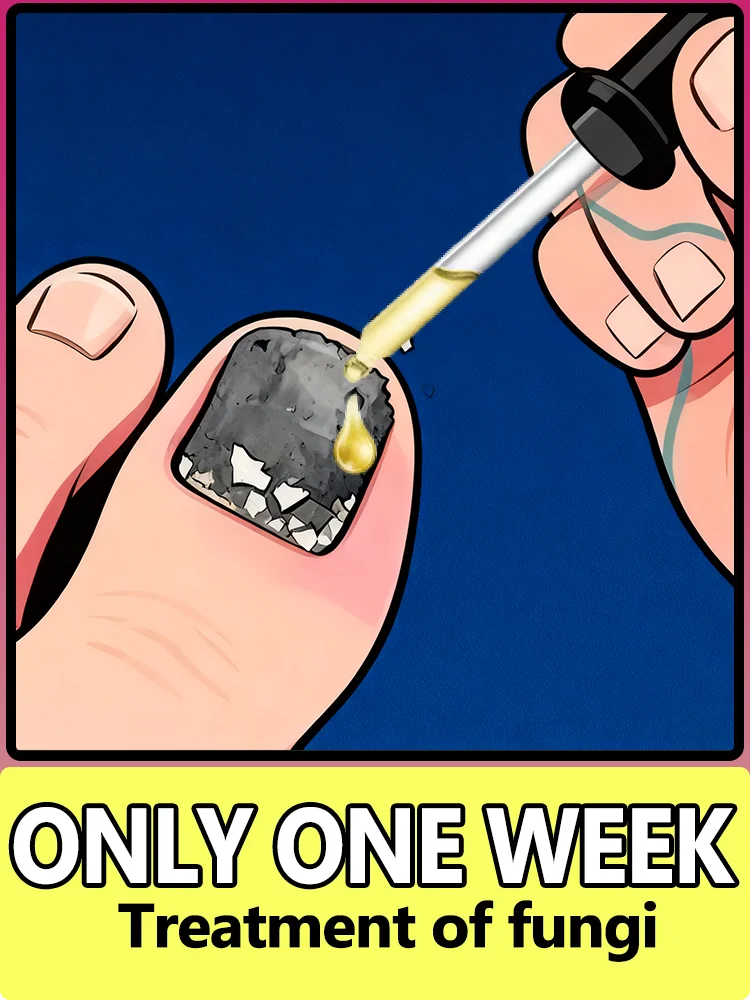 وقت دقيق، دفعة طازجة من العدوى الفطري وعلاج وبري #1