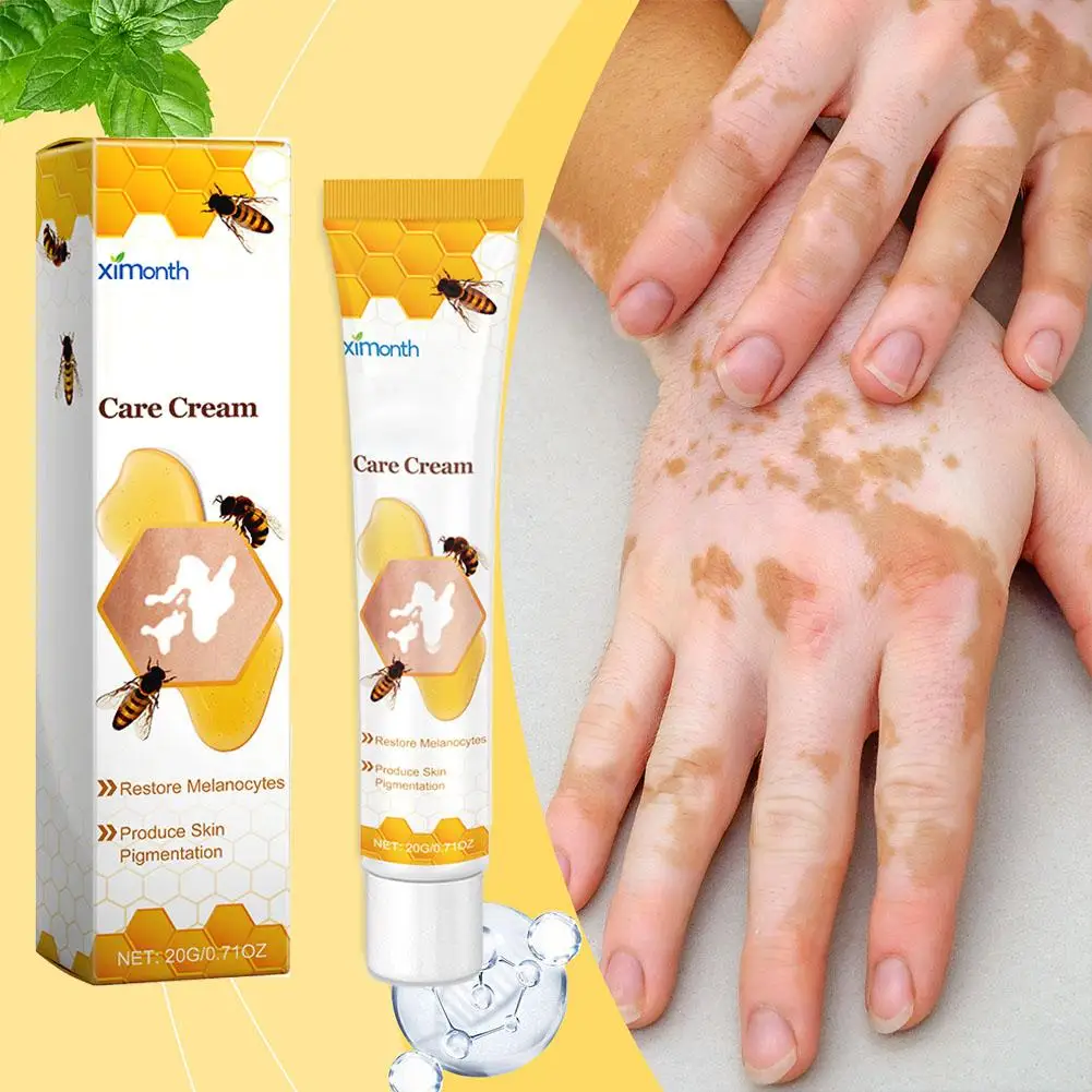 Crema de tratamiento de Vitiligo para reparación de abejas, cuidado de la piel, promueve la producción, inhibe las manchas blancas, alivia la propagación, crema de tratamiento