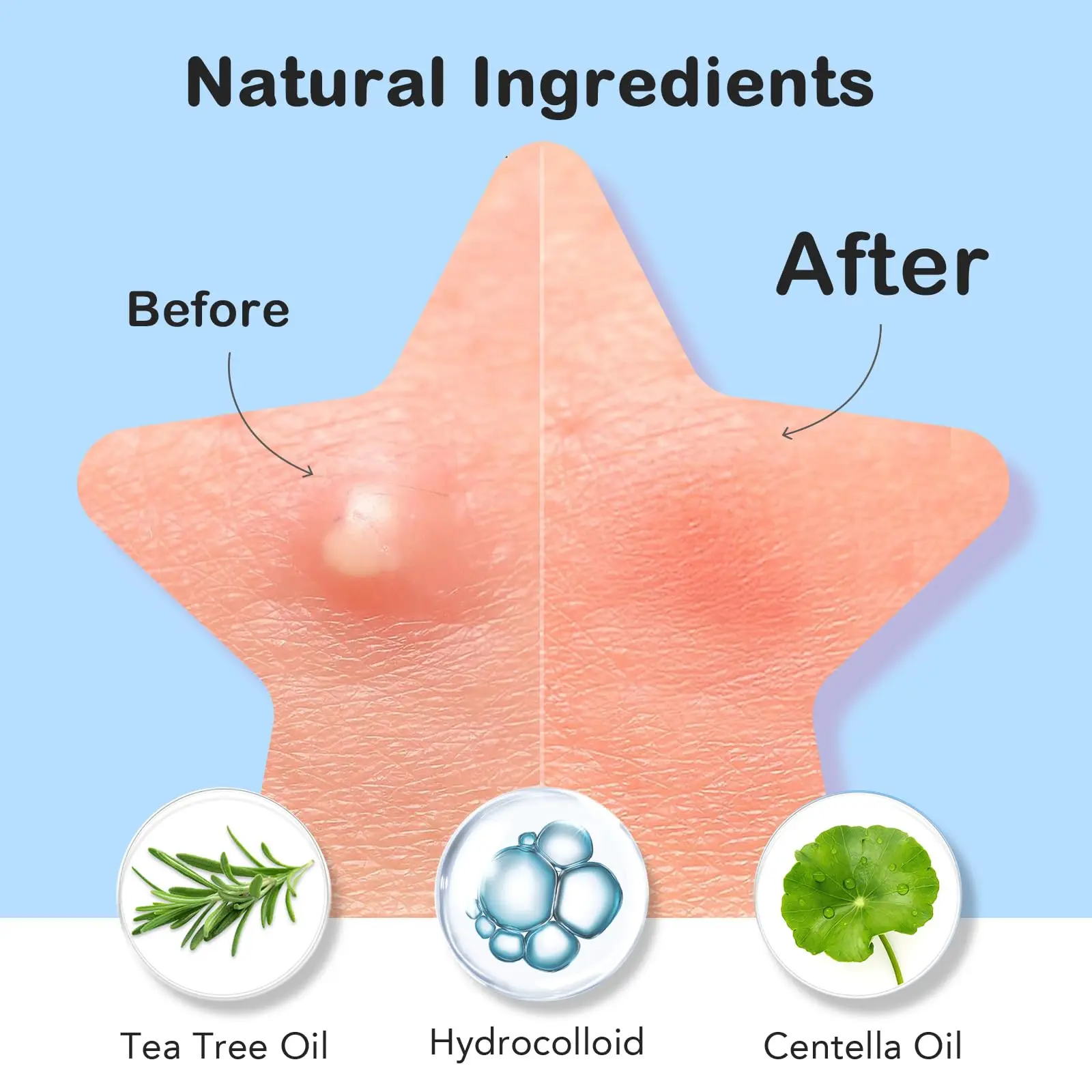 142 رقعة/صندوق لحب الشباب هيدروجيل، رقع تنظيف عميق لحب الشباب، تخفيف وتغطية حب الشباب بشكل فعال، تنطبق على جميع البشرة #3