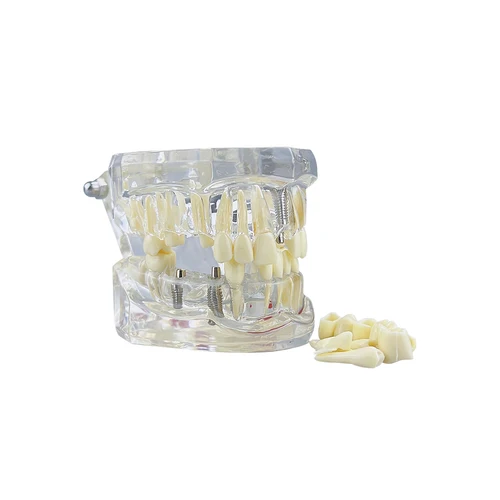 Imagen 2 del producto Modelo de dientes dentales estándar, implante, enfermedad, dentista, estudio, demostración, modelo tipodont Dental con puente de restauración de dientes extraíble