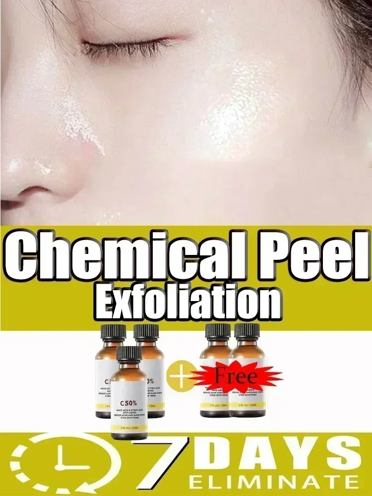 With Malic Acid And Citric Acid For Face  Facial Peel 40% Peeling Serum Peeling Serum Chemical Peel