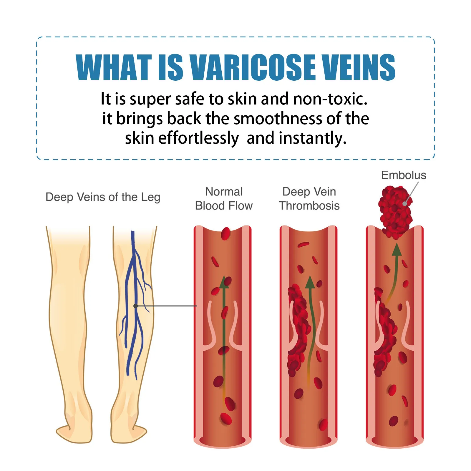 Venoheal Varicose Vein Ease Paste Varicose Veins Paste Varicose And Spider Veins Ease For Legs Improve Blood Circulatio party