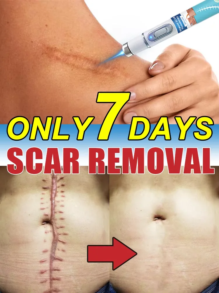 

ᔆᶜᵃʳ ʳᵉᵐᵒᵛᵃˡ⸴ ʳᵉᵖᵃⁱʳ⸴ ˢᶜᵃʳ ʳᵉᵐᵒᵛᵃˡ⸴ ᵇᵘʳⁿ ʳᵉᵐᵒᵛᵃˡ⸴ ᶜᵉˢᵃʳᵉᵃⁿ ˢᵉᶜᵗⁱᵒⁿ⸴ ʰʸᵖᵉʳᵖˡᵃˢⁱᵃ⸴ ᵖʳᵒᵗʳᵘᵈⁱⁿᵍ ˡᵘᵐᵖˢ