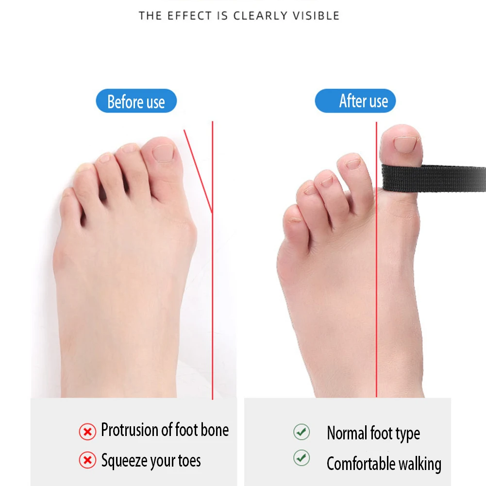 Correcteur d'oignon, soulagement de la douleur au pied, redresseur d'oignon, ceinture extensible, redresseur de gros orteils pour un alignement correct pour femmes et hommes