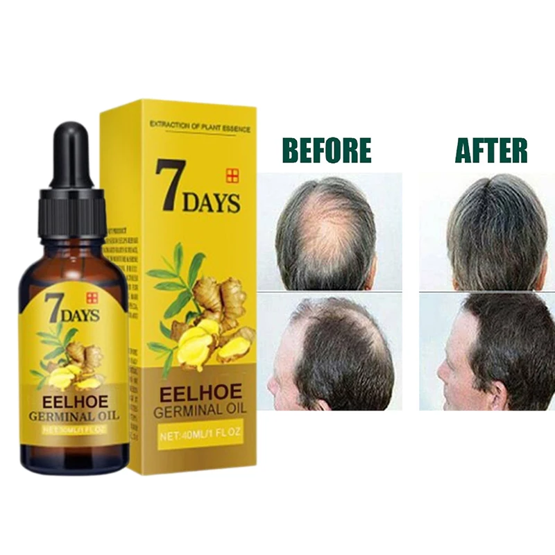 

Hair Growth Essence Oil Anti Hair Loss Treatment Hair Scalp Regrowth Nourish Repair Hairs Care Ginger Product for Men Women