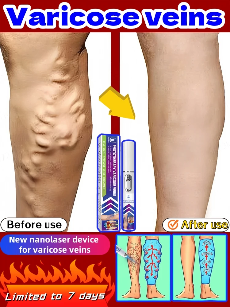 

New nano laser device for varicose veins, high quality varicose vein device