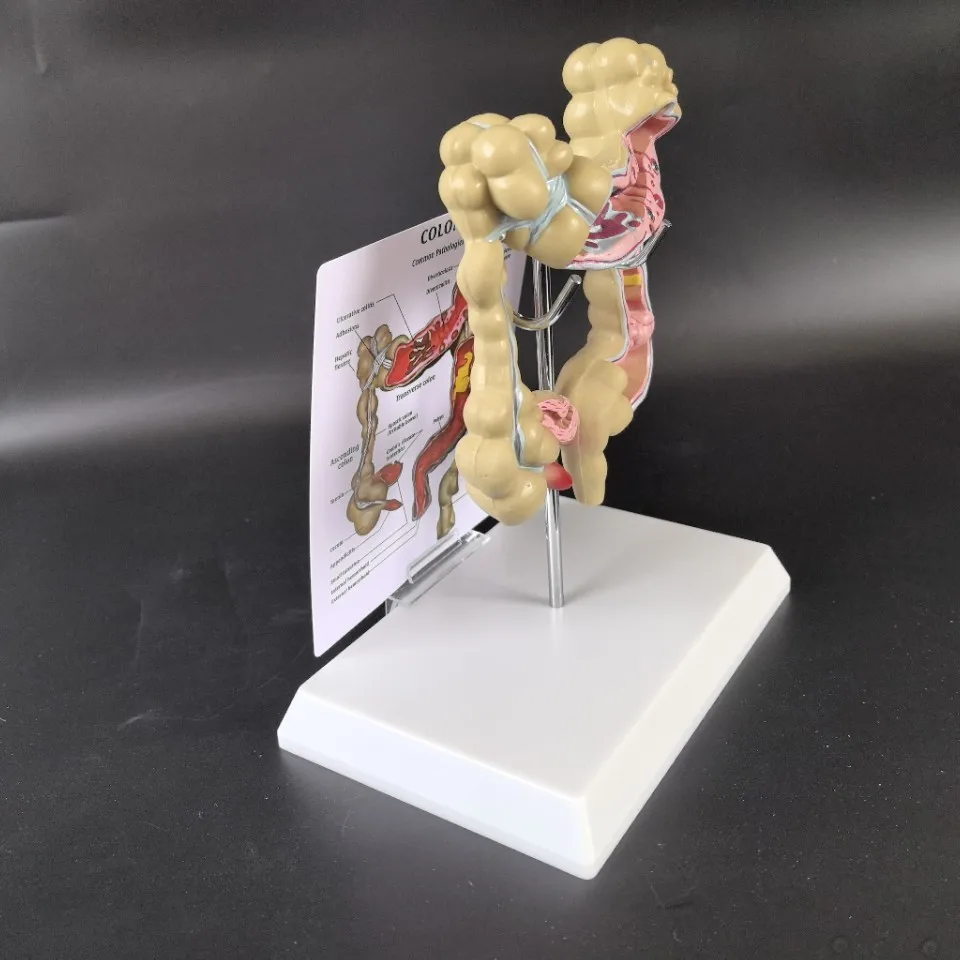 Human colon pathology teaching model, medical clear anatomy model of large intestine