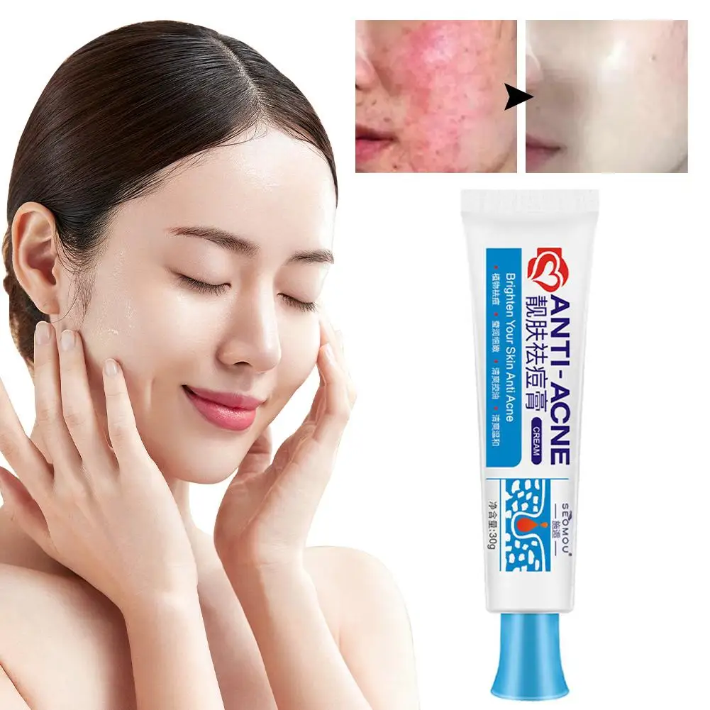 25G Acne Verwijderingscrème Anti-Acne Gel Effectieve Behandeling Puistje Spot Litteken Mee-Eterolie Controle Vochtinbrengende Crème Huidverzorging