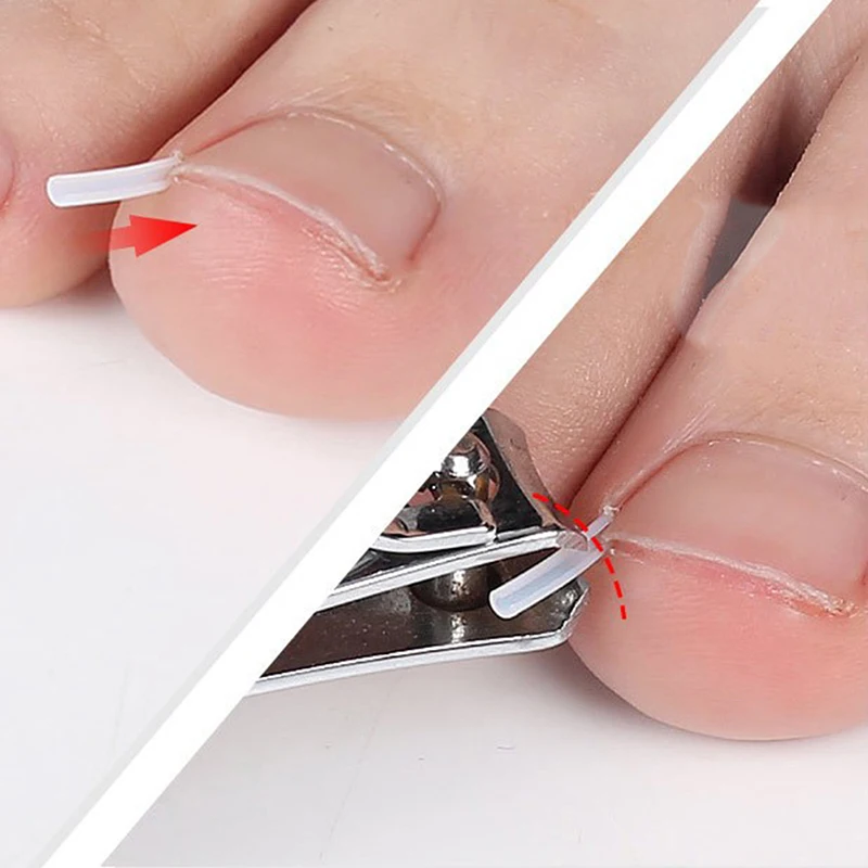 10 Stks/pak Teennagel Rechttrekken Clip Ingegroeide Teennagel Correctie Tool Nail Behandeling Elastische Patch Sticker Voetverzorging Pedicure