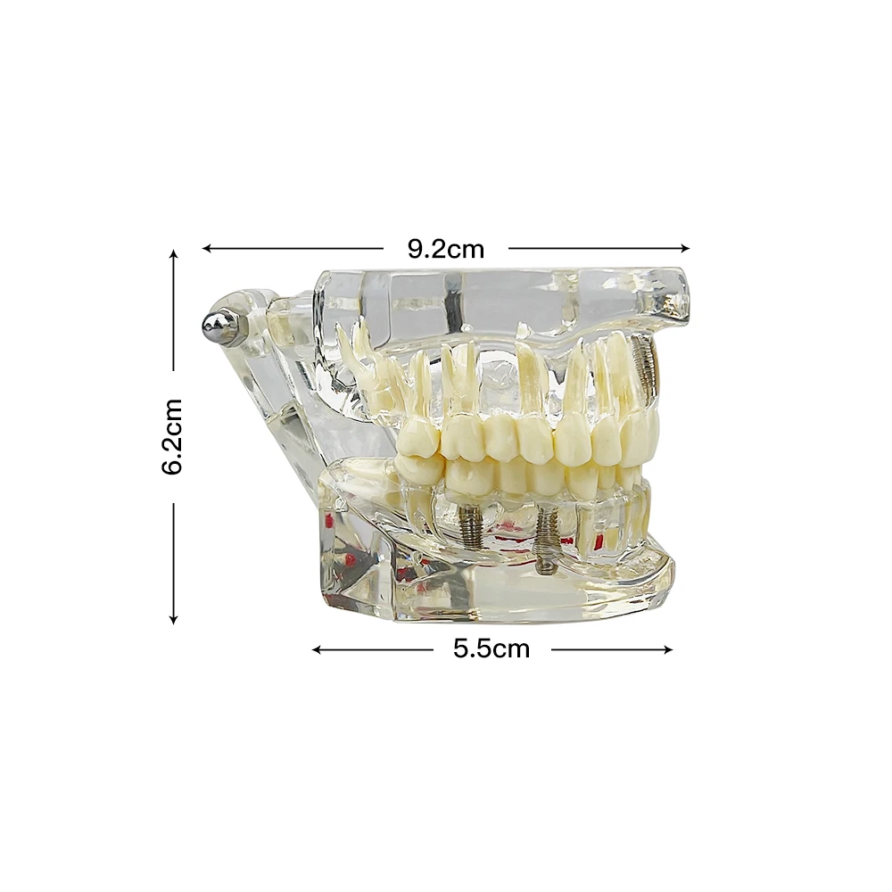 1Pcs Dental Oral Typodont Model Disease Teeth Model With Dental Implant Bridge Removable Teeth Dentist Education Demonstration