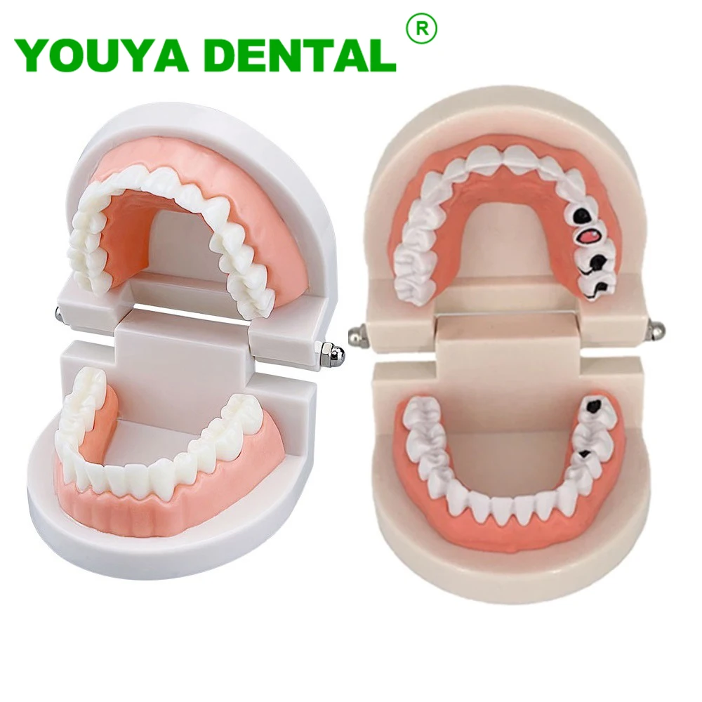 

Dental Education Model With Caries Tooth Standard Teeth Model Dentist Teaching Study Typodont Brushing Teeth Demonstration Tools