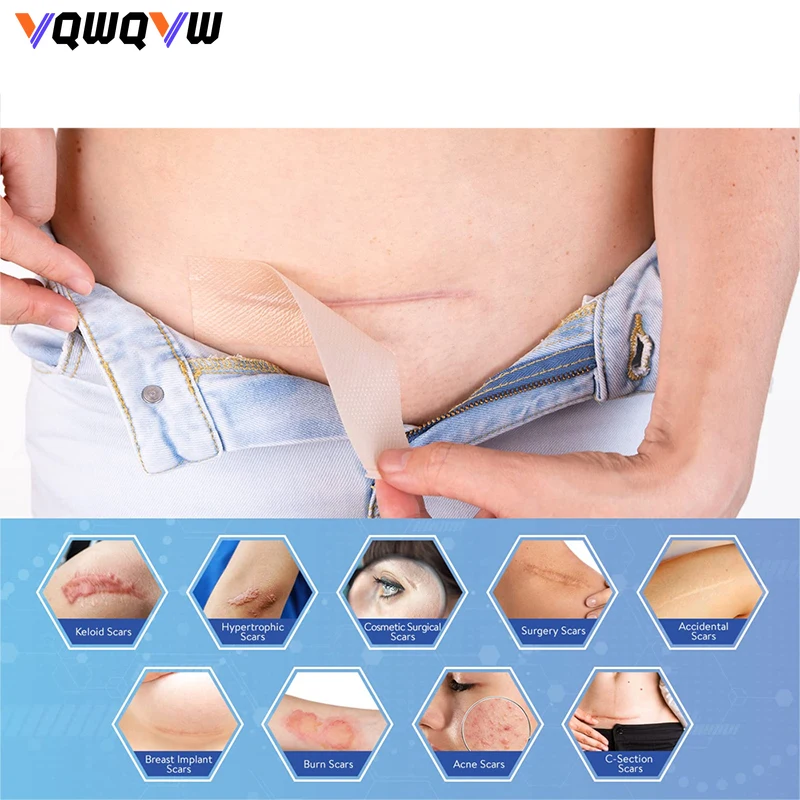1Roll  Silicone Scar Tape for Keloid,Surgery,C-Section,Acne,Chronic Wounds Soft,Non-Irritating,WaterResistant