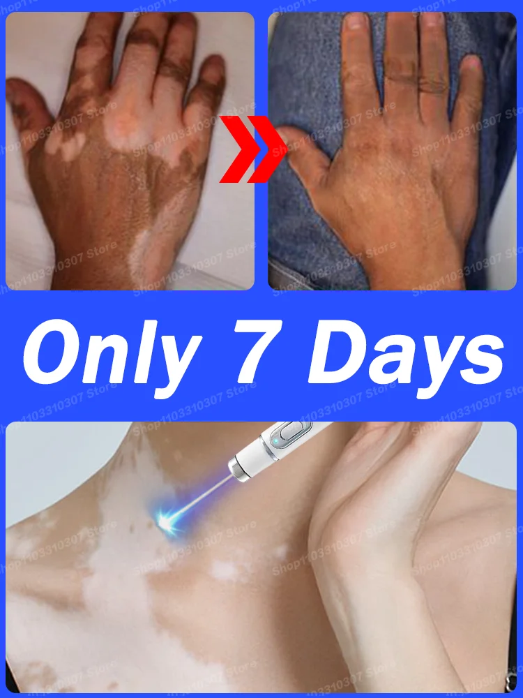 White spots vitiligo Disappear