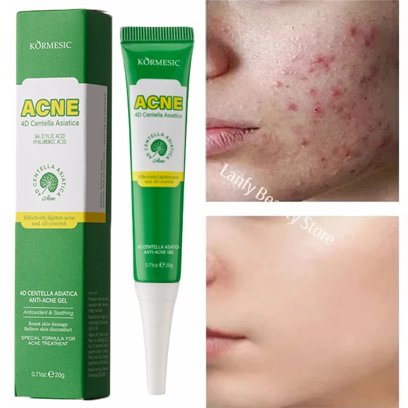 

Salicylic Acid Acne Treatment Face Gel Repair Pimple Spots Deep Cleaning Pore Anti-acne Scar Oil Control Moisturizer Skin Care