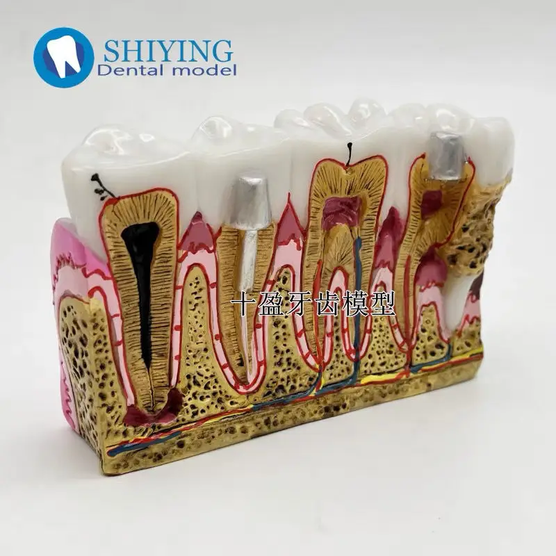 Dental Oral Teaching Model Caries Development Demonstration Crystal Adult Pathological Model Dental Anatomy Display