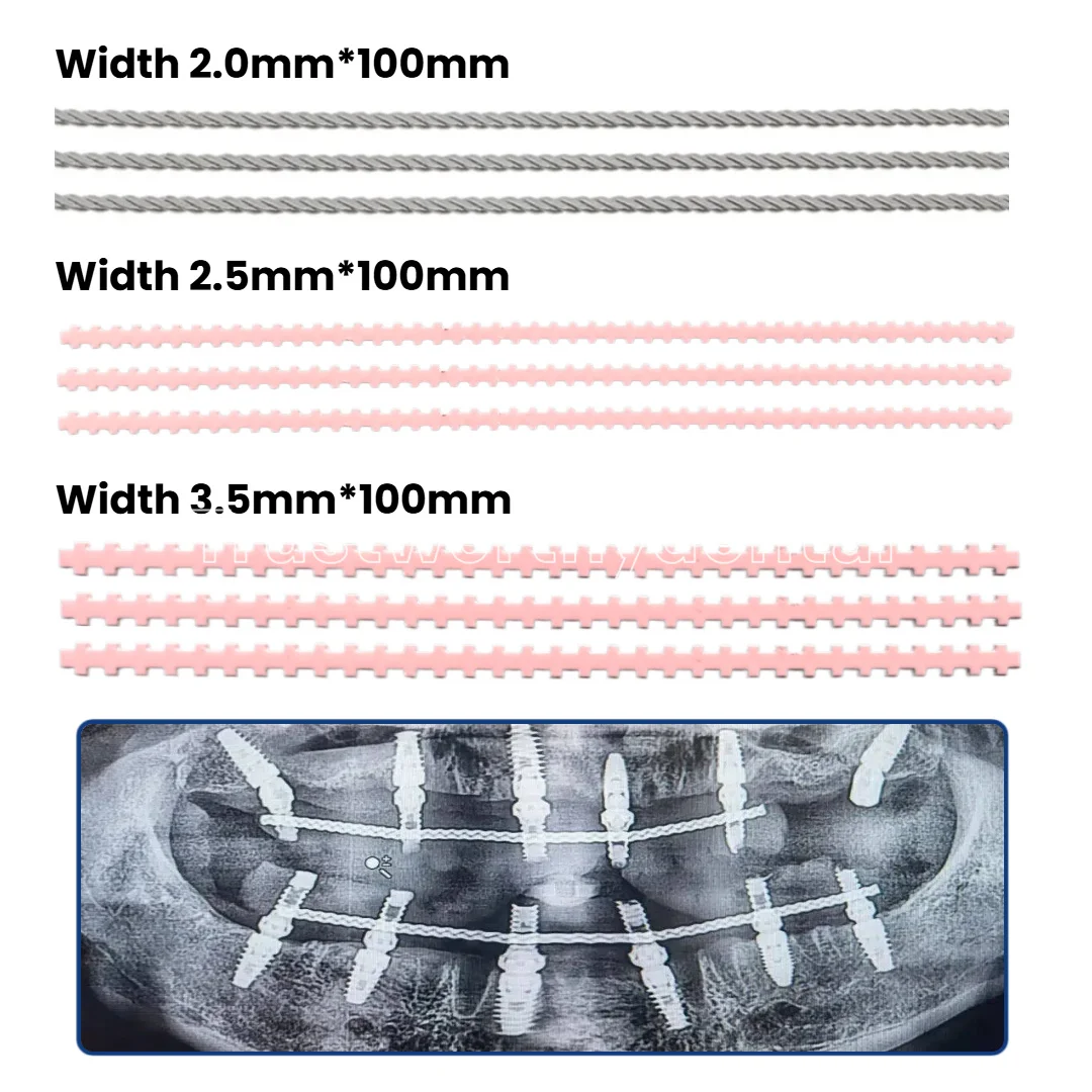 

Dental Implant Twist Strengthener Wires Implant Connector Overdenture Retainer MU Wires Retainer Full Arch Immediate Restoration