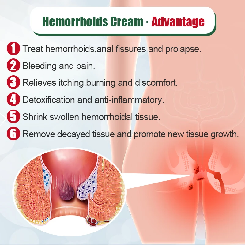 Creme da remoção do hemorroid, pomada médica, inchaço anal, alívio das dores, anti-inflamatório, hemostasia S051