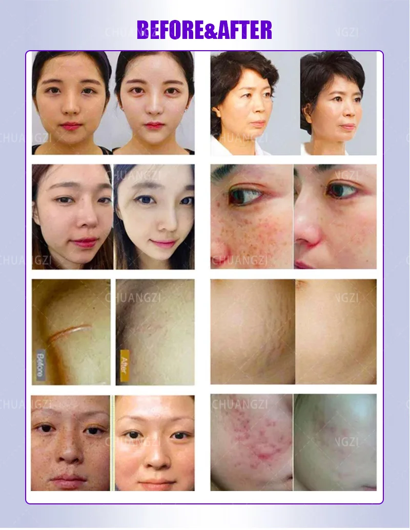 2 In 1 Fractional RF Microneedling Machine Portable Radio Frequency Skin Tightening Device With Cold Hammer For Face Neck Stretc