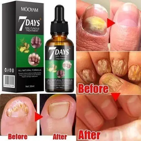 

Nail Repairing Liquid Essence Hand Care Foot Fungal Removal Repair Serum Anti-infective Paronychia Nail Polish Repair Products