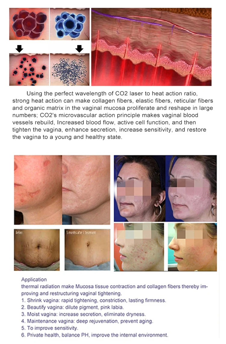 Dot Matrix Skin Beauty Facial Acne Removing Light Lines Portable Repair Stretch Marks Beauty