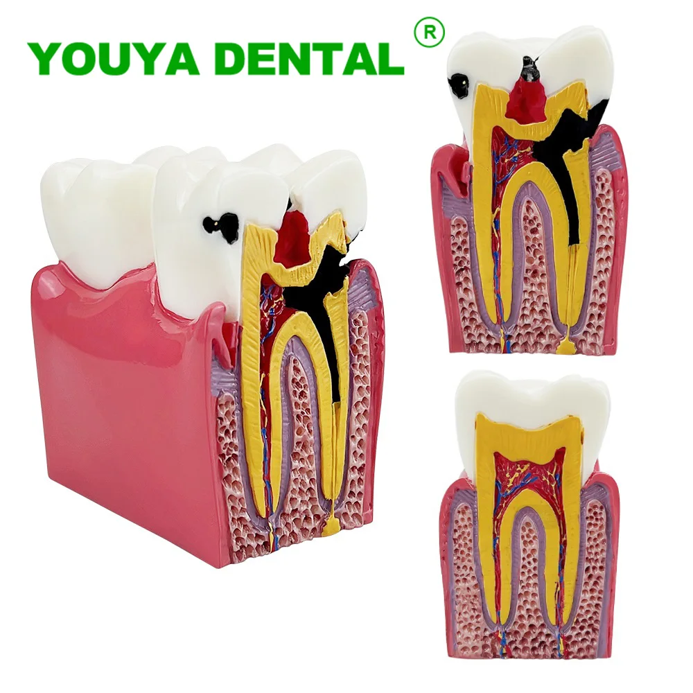 Dental Study Teaching Model 6 Times Dental Caries Comparsion Models Dentistry Anatomy Teeth Model Dentist Demonstration Model