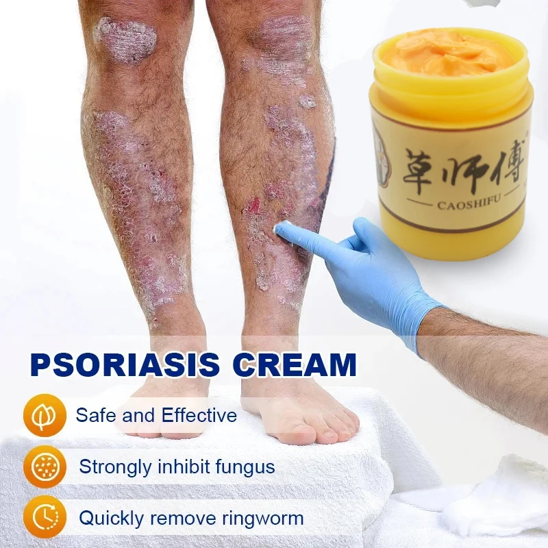 15g caoshifu eczema psoríase pomada prurido dermatite antibacteriana erval creme eczematoid anti-coceira cuidados com os pés