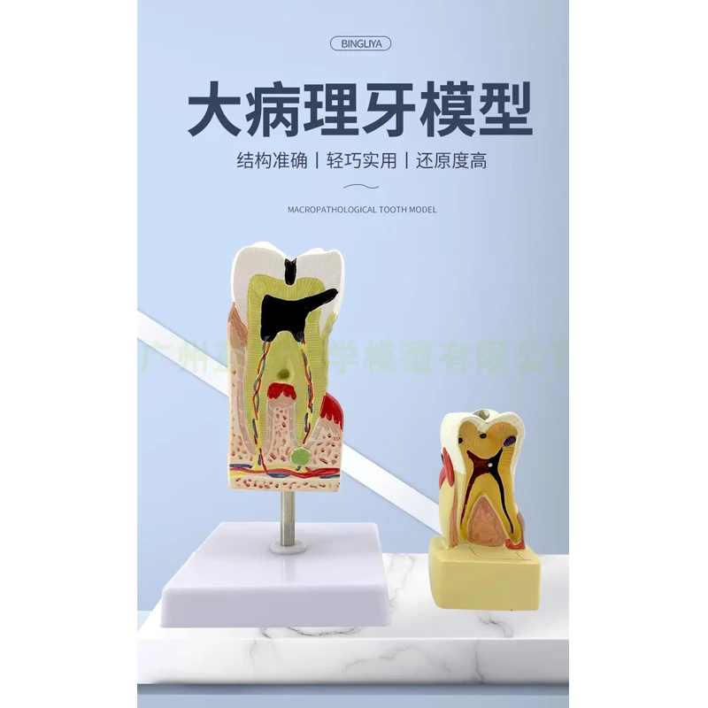 Dental cavity model, comprehensive pathological model of dental diseases, dental anatomical profile model, dental doctor-patient