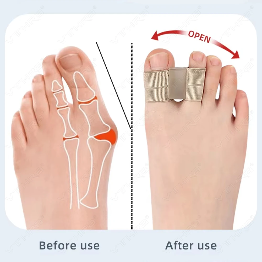 2Pcs 1Pair Hallux Valgus Bunion Corrector Toe Separator Orthotics Feet Bone Thumb Adjuster Correction Pedicure Feet Straightener