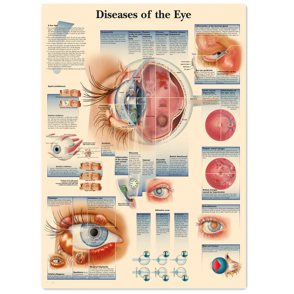 Diseases of the Eye Vintage Medical Posters and Prints Human Anatomy Wall Art Painting Wall Chart Hospital Clinic Home Decor