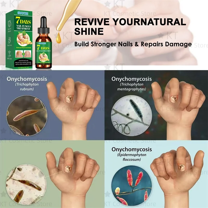 7 日間真菌爪治療血清足の爪真菌除去修復ジェル抗感染爪周囲炎爪真菌症足の爪ケア