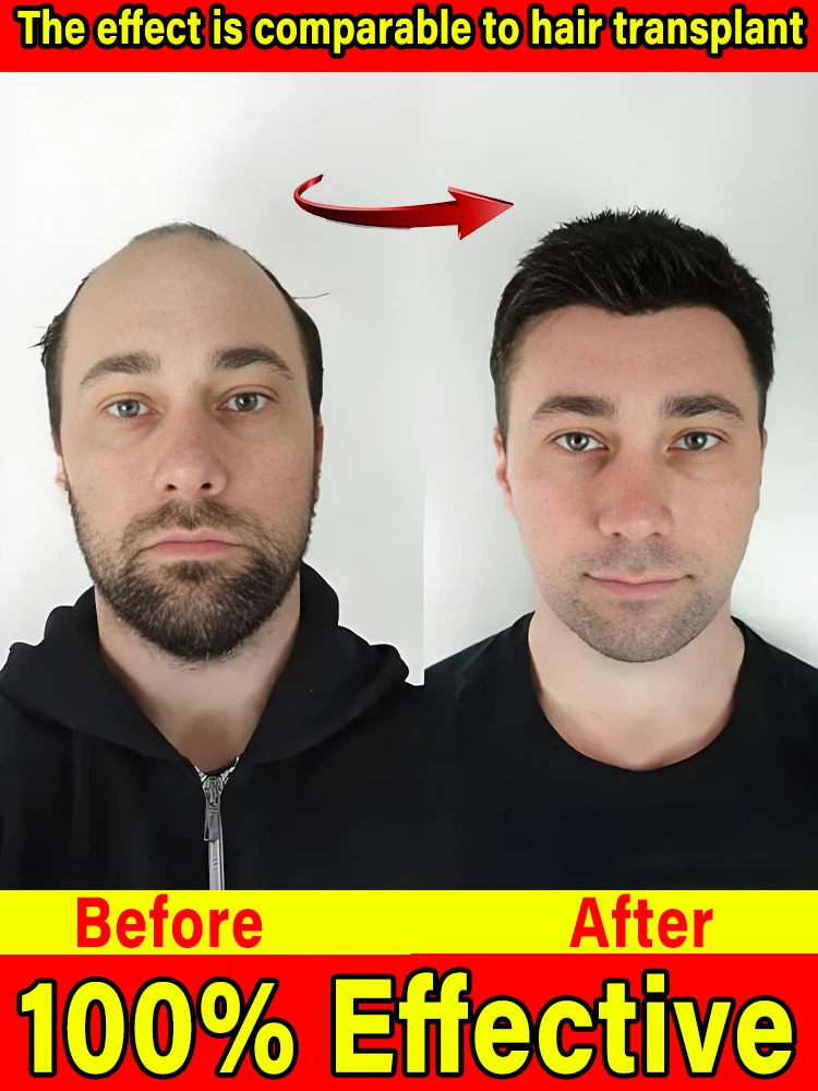 

Rᴀᴘɪᴅ ɢʀᴏᴡᴛʜ ʜᴀɪʀʟɪɴᴇ ᴄᴀʀᴇ sᴄᴀʟᴘ ᴛᴏ ᴘʀᴇᴠᴇɴᴛ ʜᴀɪʀ ғᴏʟʟɪᴄʟᴇ sʜᴇᴅᴅɪɴɢ ᴇssᴇɴᴄᴇ ɴᴜᴛʀɪᴇɴᴛ sᴏʟᴜᴛɪᴏɴ ғᴏʀ ᴍᴇɴ ᴀɴᴅ ᴡᴏᴍᴇɴ