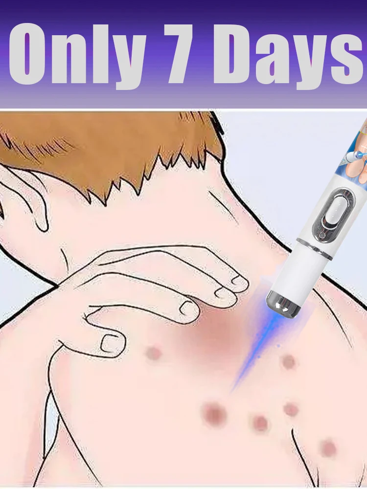 イボ除去ブルーライト、売れ筋イボケアツール