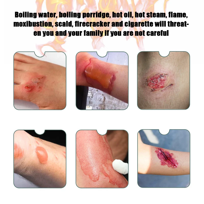 Burncare Relieve Burn Gel Burn Dressing Cooling Soothing Hydrogel Wound Dressing Effective Water Gel Burn Dressing Burn Injury